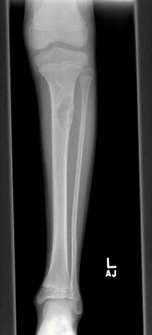 صورة توضيحية لـ الورم الليفي غير المتعظم: دليل شامل للمرضى مع الأستاذ الدكتور محمد هطيف