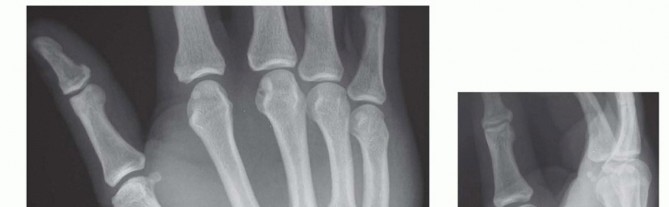 Operative Treatment of Finger Carpometacarpal Joint Fracture-Dislocations