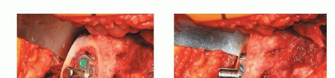 Illustration 18 for Uncemented THA: Critical Soft Tissue Tension for Joint Stability