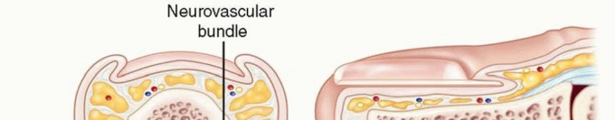 Surgical Treatment of Acute and Chronic Paronychia and Felons
