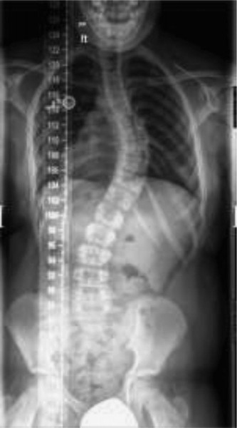 Mastering Hemivertebra Unilateral Bar Diagnosis: 12 Cases