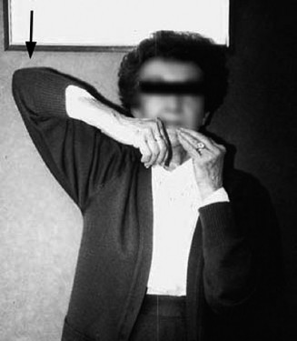 Illustration 2 for Elbow Cases: Rotator Cuff Tear Solutions & Insights