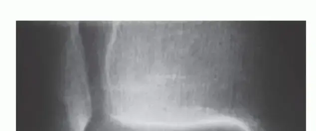 آفات الغضروف والعظم في الكاحل (OCLT): دليل شامل للمرضى في اليمن والخليج