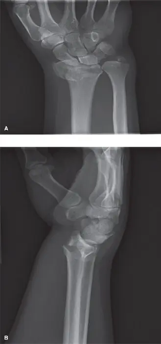 صورة توضيحية لـ كسر الكعبرة البعيدة المعقدة داخل المفصل: دليل شامل للمرضى في صنعاء