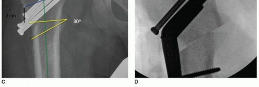 Illustration 28 for Periacetabular Osteotomy: Realigning your hip via the superior pubic ramus
