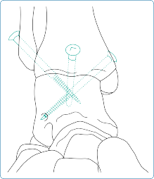 Illustration 1 for What to Expect: Ankle Surgery Postoperative Care & Instructions