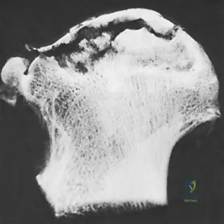 Illustration of conditions of bone - Dr. Mohammed Hutaif