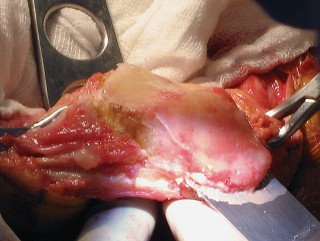 Illustration 47 for Posterior Stabilized Technique: Essential Insights for TKA Success