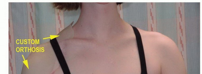 صورة طبية: استئصال أورام الكتف مع الحفاظ على الطرف: أحدث التقنيات لنتائج مثالية مع الأستاذ الدكتور محمد هطيف