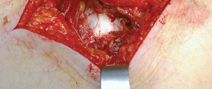 Illustration 21 for Unlock the Figure Posterior Approach to the Hip