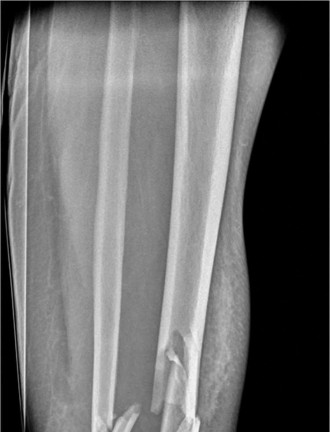 Challenging case of pilon fractures: Staged management