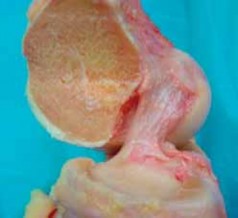 Mastering Anatomic Double-Bundle Anterior Cruciate Ligament Reconstruction