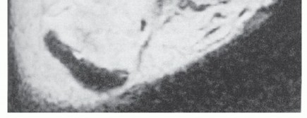 Illustration 12 for Beyond Primary Repair: Solutions for Peroneal Tendon Subluxation