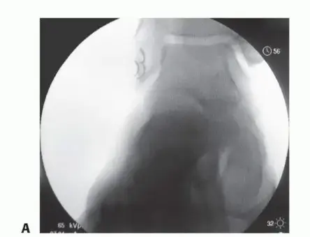 صورة توضيحية لـ عدم استقرار الكاحل المزمن: الأسباب، الأعراض، والعلاج الشامل لاستعادة الثبات والحركة