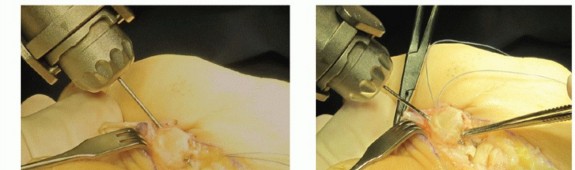 Illustration 26 for Plantar Plate Repair: End Lesser Toe Pain & Instability
