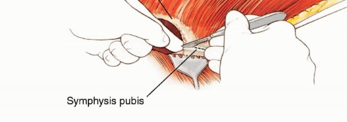 صورة طبية: استئصال نصف الحوض بالرفرفة الأمامية: حلول متقدمة لأورام الحوض الصعبة مع الأستاذ الدكتور محمد هطيف في صنعاء