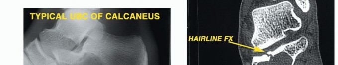 صورة توضيحية لـ أورام القدم: دليلك الشامل للعلاج، البتر، والاستئصال مع الأستاذ الدكتور محمد هطيف في صنعاء