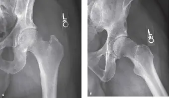 صورة توضيحية لـ فشل تثبيت كسور الورك: الأسباب، الأعراض، العلاج، والوقاية مع الأستاذ الدكتور محمد هطيف