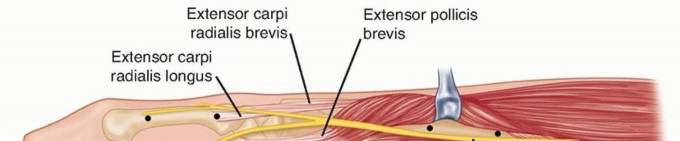 K-Wire Fixation of Distal Radius Fractures with and without External Fixation