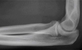 Illustration 12 for Master Diagnosis: Shoulder & Elbow Cases (Reproduced with Permission)