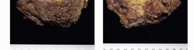 صورة طبية: جراحة أورام العجز: الحفاظ على وظائف الأمعاء والمثانة مع الأستاذ الدكتور محمد هطيف في صنعاء