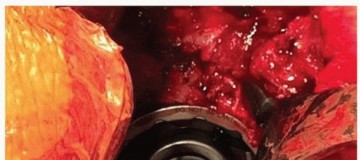 صورة طبية: تثبيت مفصل الورك بدون أسمنت: دليل شامل لمرضى استبدال الورك مع الأستاذ الدكتور محمد هطيف