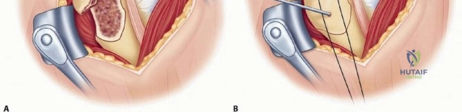 Orthopaedic Board Review: Forearm & Wrist Fracture MCQs for ABOS Part I & AAOS OITE | Part 21579