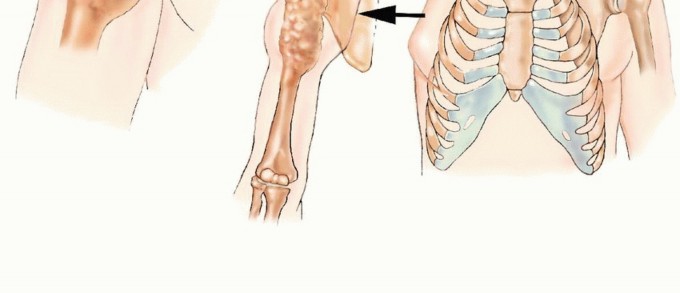 Forequarter Amputation diagram 2