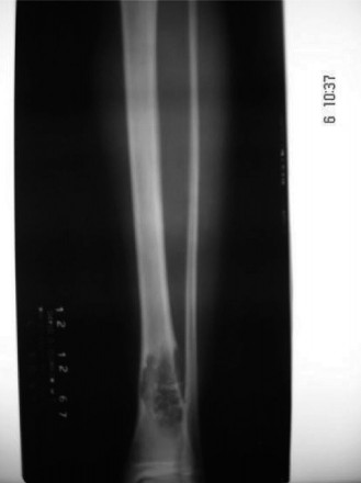 Illustration of oncology cases chondromyxoid - Dr. Mohammed Hutaif