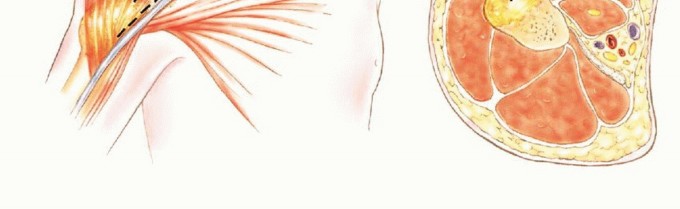 صورة طبية: استئصال أورام الكتف مع الحفاظ على الطرف: أحدث التقنيات لنتائج مثالية مع الأستاذ الدكتور محمد هطيف