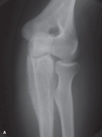 Illustration of ewing sarcoma orthopedic - Dr. Mohammed Hutaif