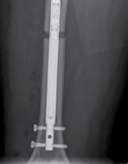 Illustration 40 for Limb Reconstruction: Restoring Function for Challenges Near and Far