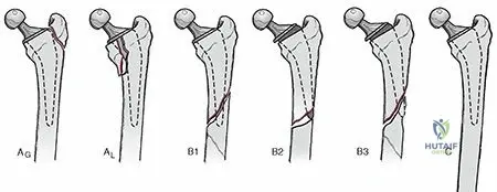 Mastering Type IV Fractures: Essential Periprosthetic Strategies