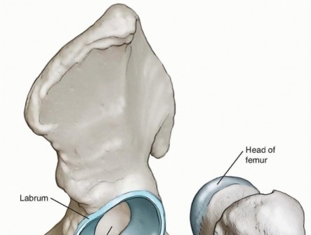 Hip Arthroscopy: Relief for the Athletic and Prearthritic Population