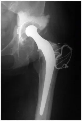 صورة توضيحية لـ قطع العظم المدوري الانزلاقي: دور حديث وتقنيات متطورة لاستعادة حركة الورك