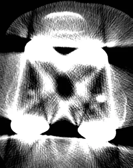 صورة توضيحية لـ سوء محاذاة مكونات مفصل الركبة الصناعي: دليل شامل للمرضى والعلاج المتقدم في صنعاء