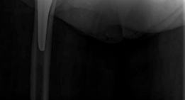 Illustration 17 for Mastering Direct Anterior Approach Hip Arthroplasty Without a Traction Table