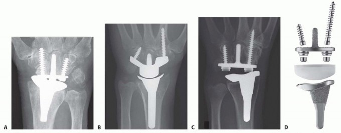 Wrist Implant Arthroplasty