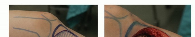 هيكل عظمي يوضح موقع الورم في العظام