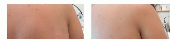 صورة طبية: الاستئصال الموجه لأورام الجهاز العضلي الهيكلي: نهج أكثر أمانًا وفعالية مع الأستاذ الدكتور محمد هطيف