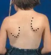 صورة توضيحية لـ تشوه سبرينغل: دليل شامل للمرضى حول الأسباب، الأعراض، وطرق العلاج في اليمن والخليج