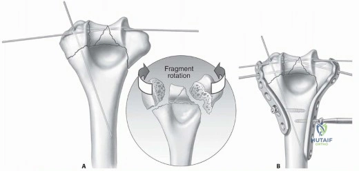 Illustration 4 for Optimizing ORIF for Distal Humerus: Prevent Class II HO