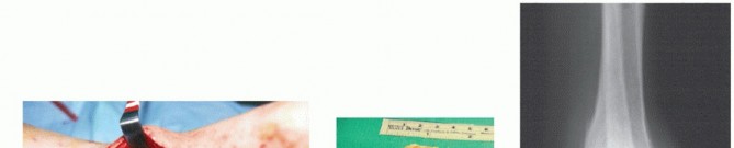 Illustration 8 for Beyond Amputation: Circular Fixation for Infection of the Talus