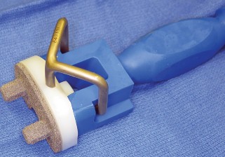 Illustration 12 for Monoblock Total Knee: When to Use & What to Avoid