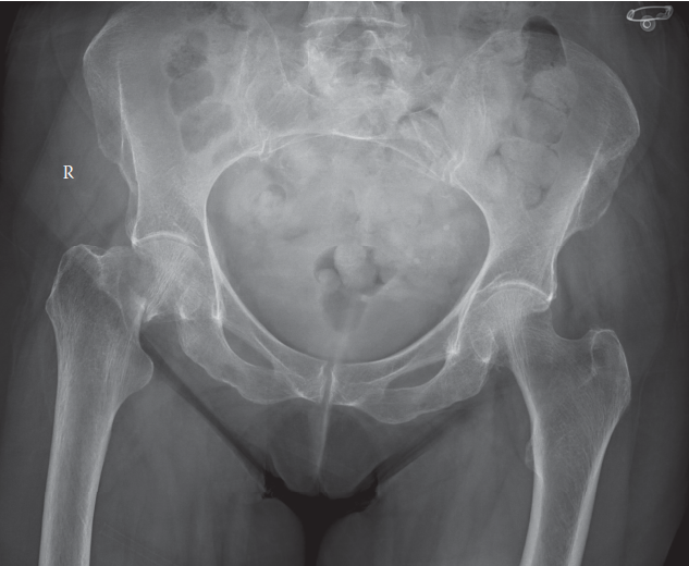 Illustration of hip fracture hip - Dr. Mohammed Hutaif