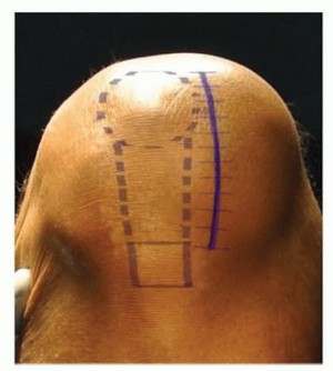 Illustration 4 for Unicondylar Knee Arthroplasty: Is This Your Solution to Knee Pain?