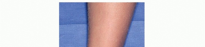 Ankle Arthroscopy: Achieving Precision Parallel to the Bimalleolar Axis