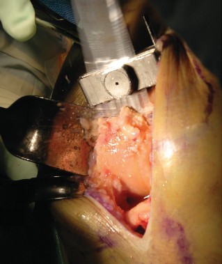 Illustration 11 for Cemented TKA Figure: Your Visual Guide to Surgical Success