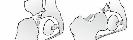 Illustration of femoral head fracture - Dr. Mohammed Hutaif