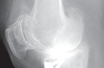 Illustration 3 for Optimize Tibial Component Alignment: Techniques for TKA Success